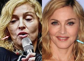 madonna-botox-face | Pop Art Zombie