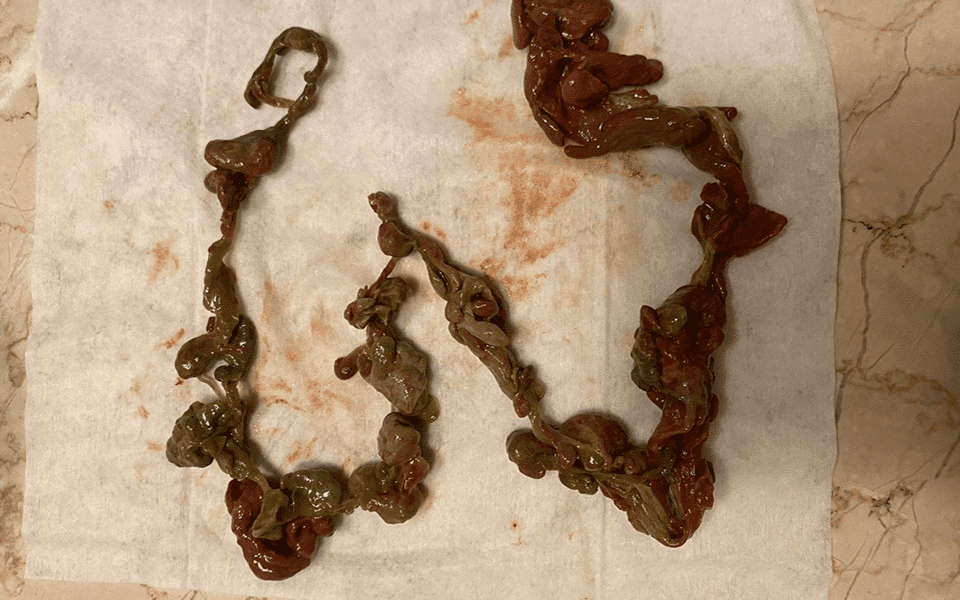 Mucoid Plaque